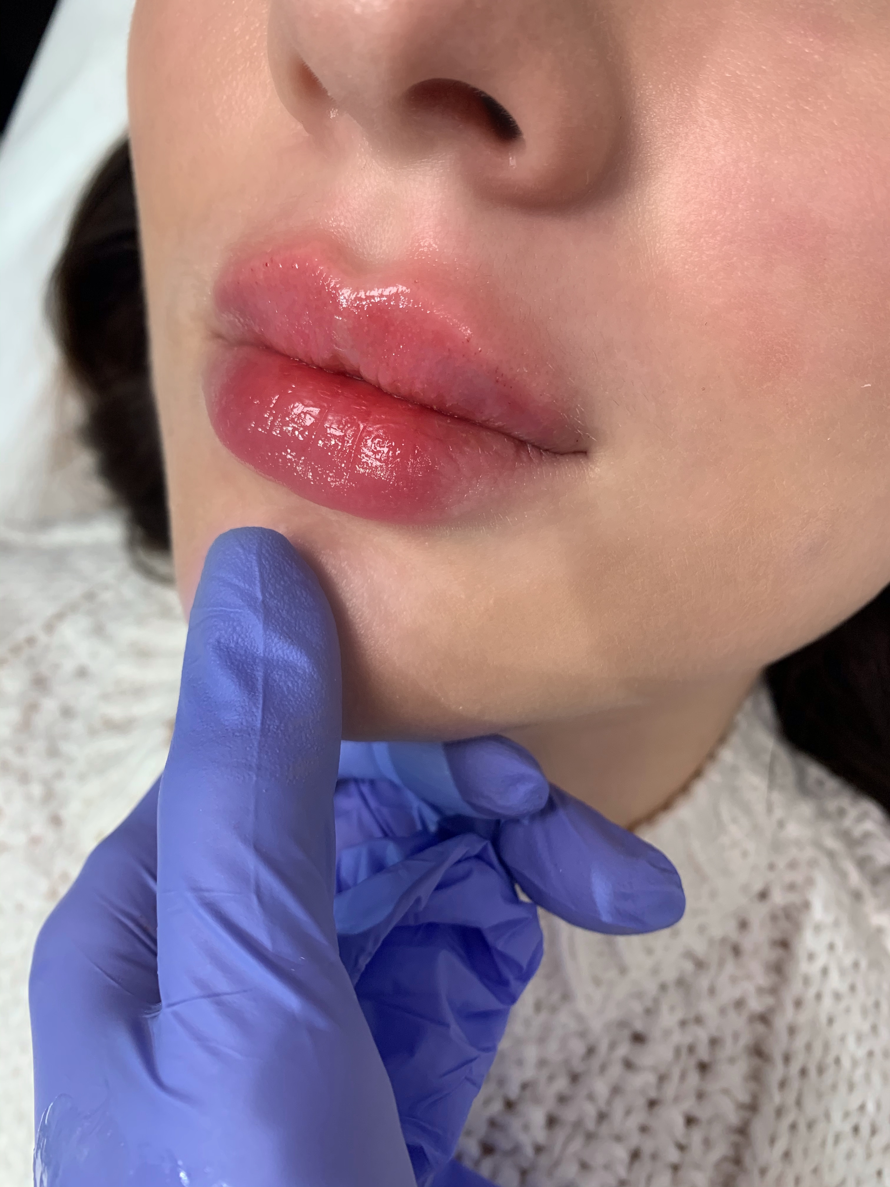 neauvia intense lips 0,5 ml.