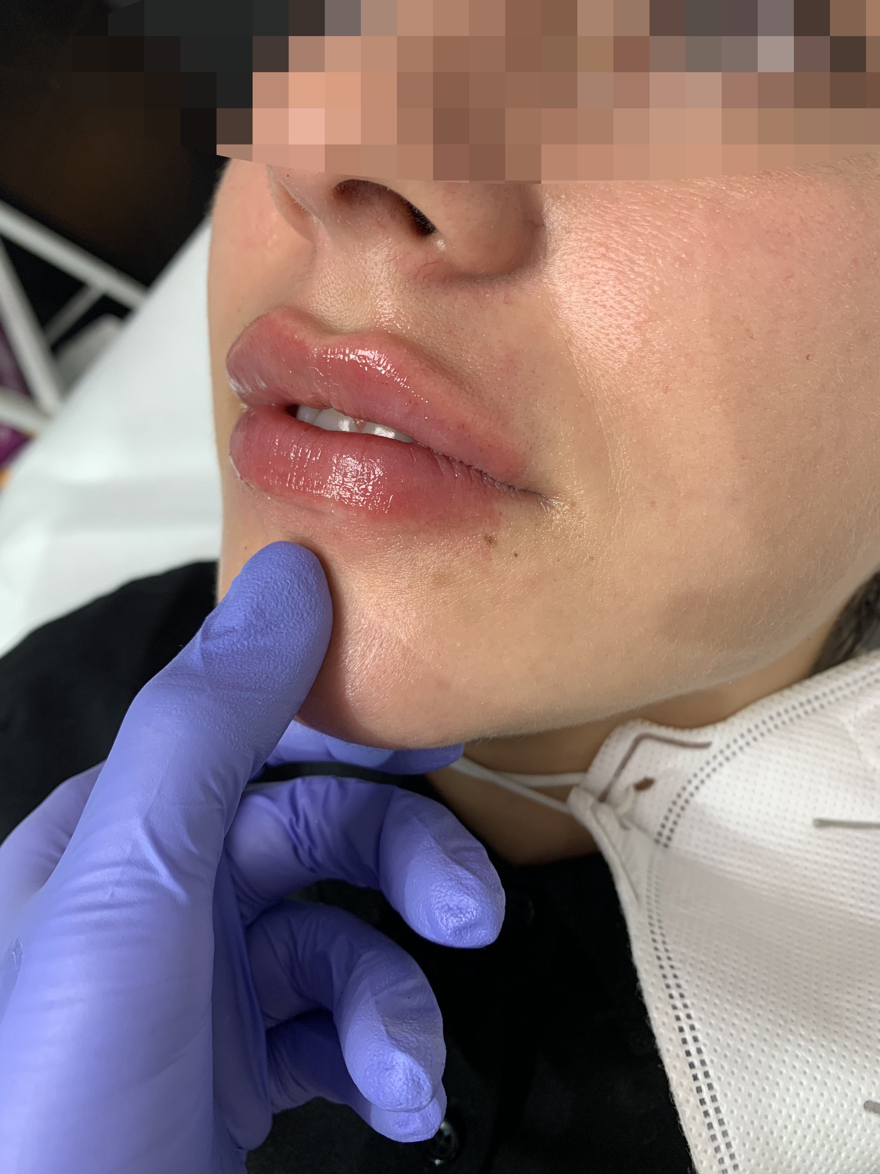 1ml preparatu Neauvia Intense Lips.