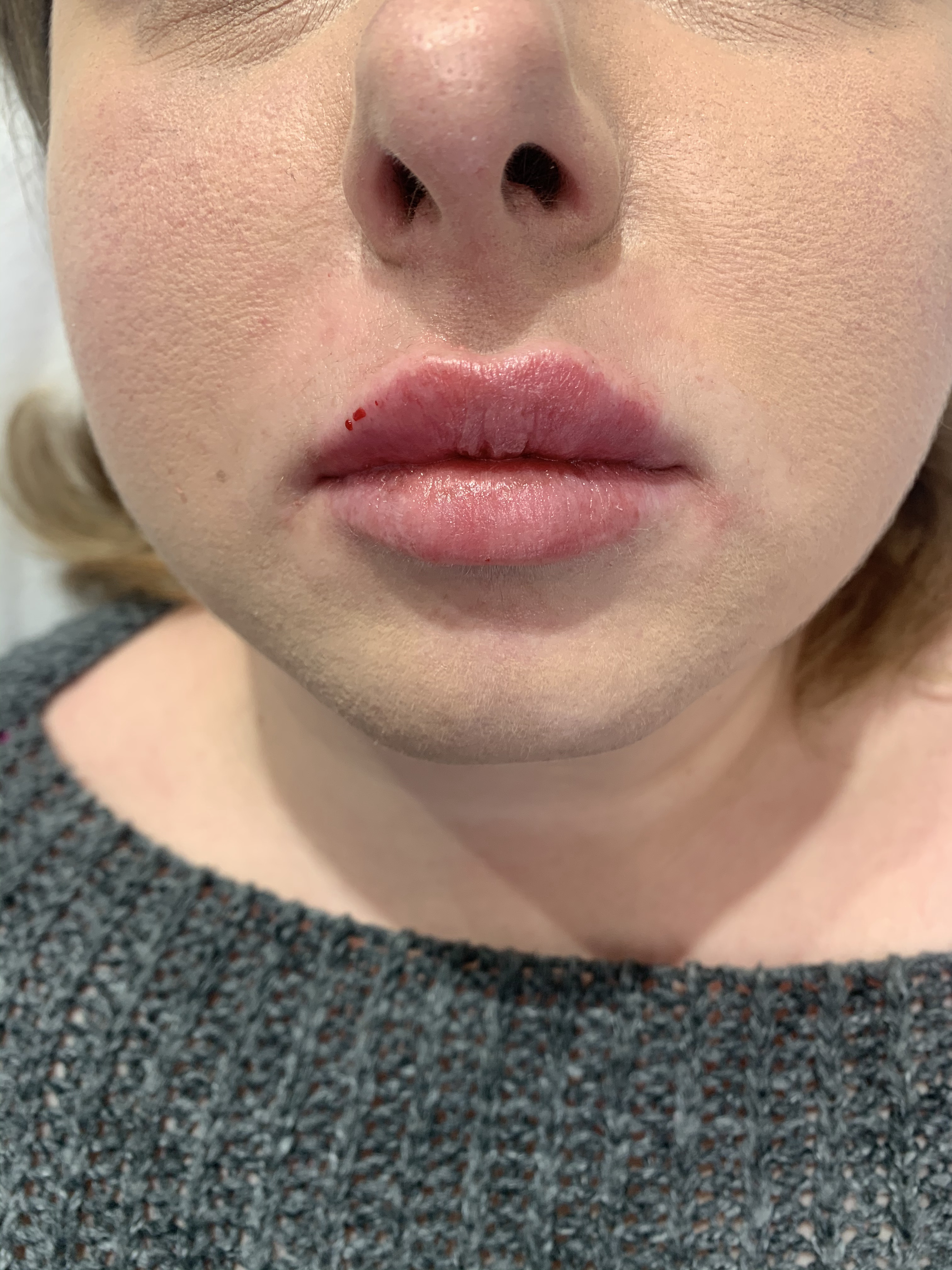 Powiększanie ust preparatem Neauvia Intense Lips 1ml.